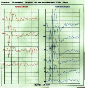 Pathological left ear: lower threshold < 90dB and higher amplitude of waves.