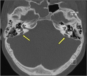 X-Linked Stapes Gusher: CT Findings in One Patient