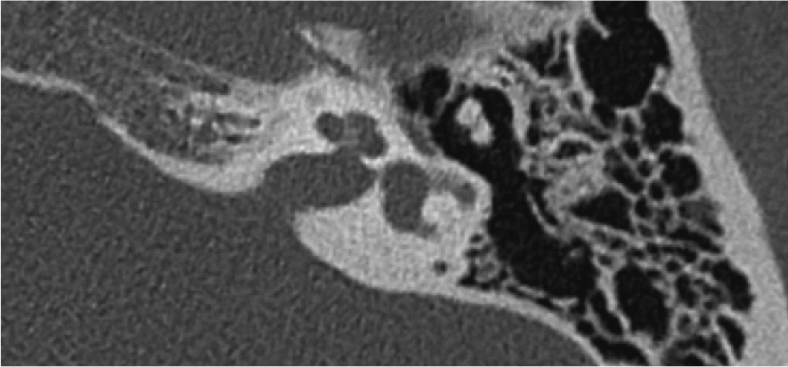 Dehiscence between the basal turn of the cochlea and the lateral end of the internal meatus