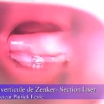 diverticule de Zenker