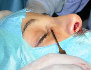 Rhinoplastie : comment éviter un affaissement du nez