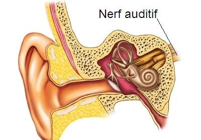 Neurinome de l’acoustique