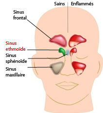 Les Sinusites de l'Enfant 
