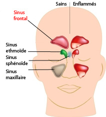 Ponction du sinus frontal uni ou bilatéral avec ou sans drainage