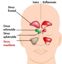 Méatotomie moyenne du sinus