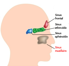 Ponction du sinus maxillaire avec ou sans drainage chez l’enfant