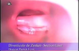 Diverticule de Zenker