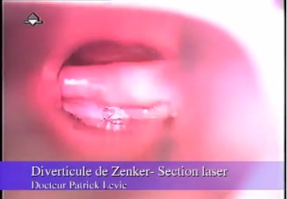 Diverticule de Zenker