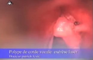 Polype de la corde vocale: exérèse au laser