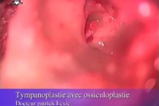 Tympanoplastie