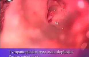 Tympanoplastie