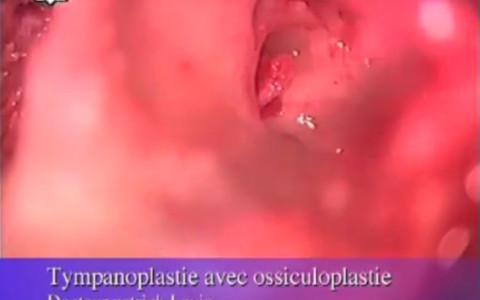 Tympanoplastie