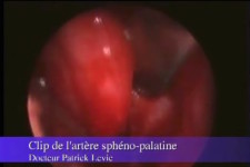 Clip de l’artère Sphéno Palatine