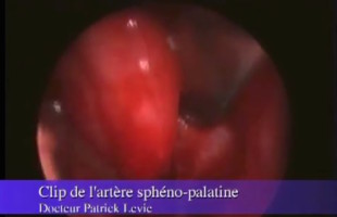 Clip de l’artère Sphéno Palatine