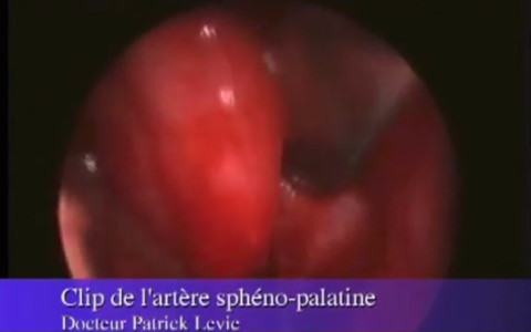 Clip de l’artère Sphéno Palatine