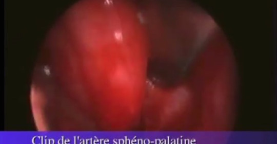 Clip de l’artère Sphéno Palatine