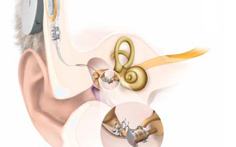 Un appareil auditif semi-implantable
